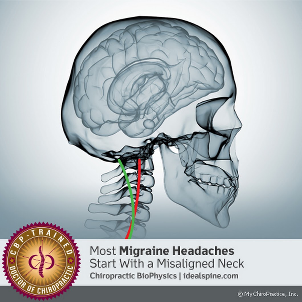 Most Migraine Headaches Start With A Misalinged Neck - The Spinal Centre